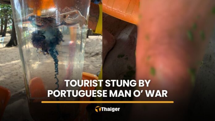 Tourist hospitalized following Portuguese man o’ war sting in Phuket